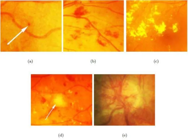Figure 3. Symptoms of diabetic retinopathy. (a) A microaneurysm, (b) hemorrhages,  (c) hard exudates, (d) soft exudate and (e) neovascularization in the optic disc