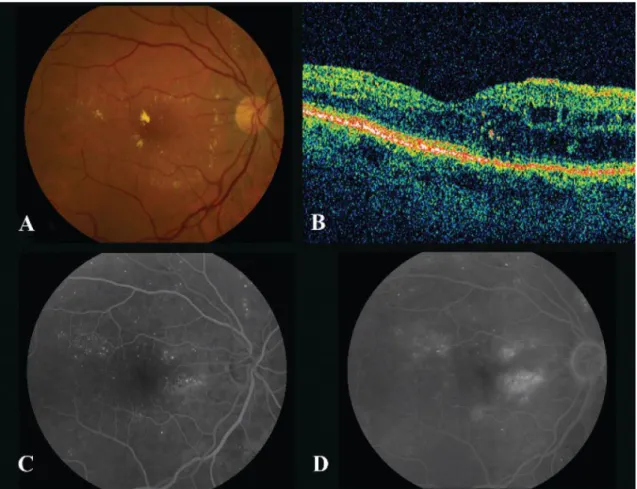 Figure 4. Retinal images. (A) Color fundus photography, (B) OCT: Optical coherence  tomography and (C–D) Fluorescein angiogram (Meyerle et al