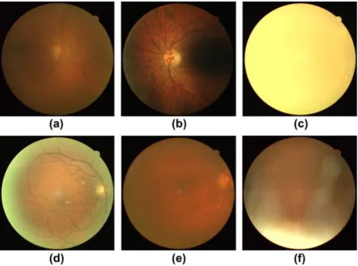 Figure 5. Retinal images with poor quality. (a) Poor focus, (b) Uneven illumination,  (c) Blinked eye, (d) Light artefact, (e) Dust and dirt (near the center) and (f) eyelash  artefact
