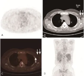 Figure 3. PET/CT reveals normal 18F-FDG metabolism of enlarged axillary lymph nodes indicating a reactive change on biopsy from a 47-year-old fe-male