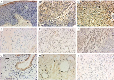 Figure 1. VISTA expression in cervical cancer. VISTA-positive tumor cells were observed in 32/104 cases (30.76%), and staining was graded as (A) weak, (B) moderate or (C) strong