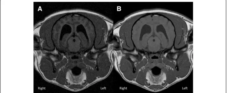 Fig. 3 a Transverse T1wFLAIR (TE/TR/TI: 16 ms/2000 ms/600 ms; NEX: 2. ms; slice thickness 3 mm; Window Level: 1359; Window Width: 2613); b) Transverse T1wTSE (TE/TR: 11 ms/470 ms; NEX: 3
