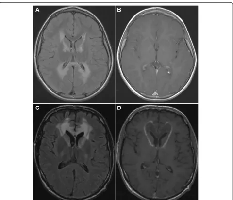 Figure 1 MRI of the brain in a case of childhood cerebral ALD showing characteristic extensive white matter changes in the parieto-frontal white matter as shown on this FLAIR image of a different patient with cerebral ALD (administration of gadolinium on a