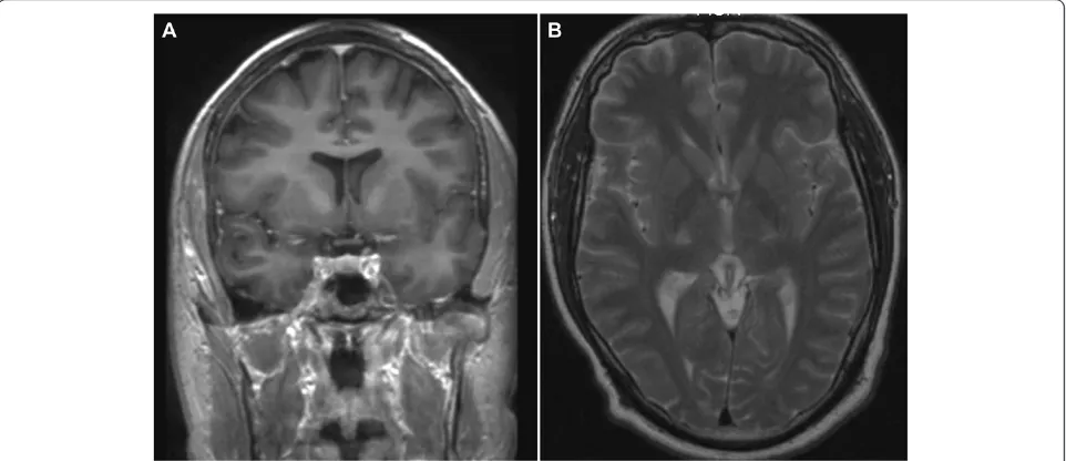 Figure 2 MRI of the brain in a patient with AMN showing increased signal in the pyramidal tracts on T2-weighed coronal (A) and axial(B) images indicative of Wallerian degeneration.