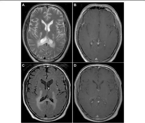 Figure 3 MRI of the brain (T2 (A) and FLAIR (C) images; T1 with gadolinium (B, D)) of a patient with AMN who rapidly deterioratedclinically with new symptoms of cognitive decline