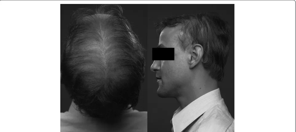 Figure 4 Thin and scanty scalp hair in a man with X-ALD (AMN phenotype). Written informed consent was obtained from the patient forpublication of these images.