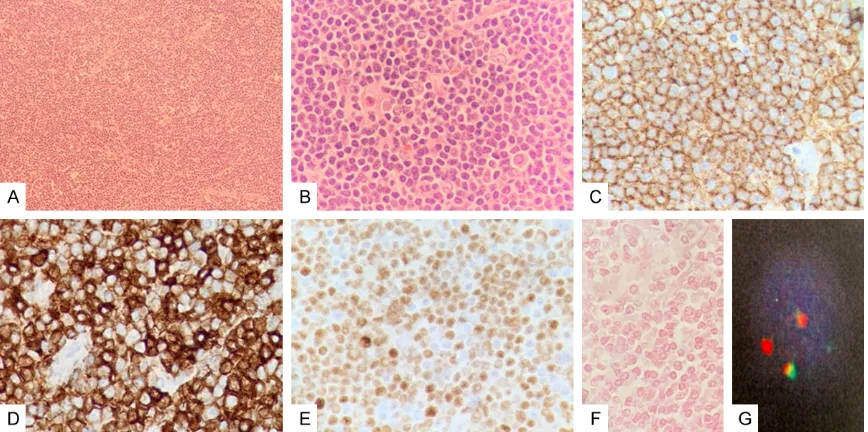 Figure 1. Histologic morphology and phenotype of tumor cells in lymph node excised in 2007