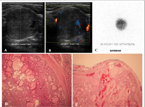 Figure 1 Imaging and histologic features of the hot nodule present in the case report subject