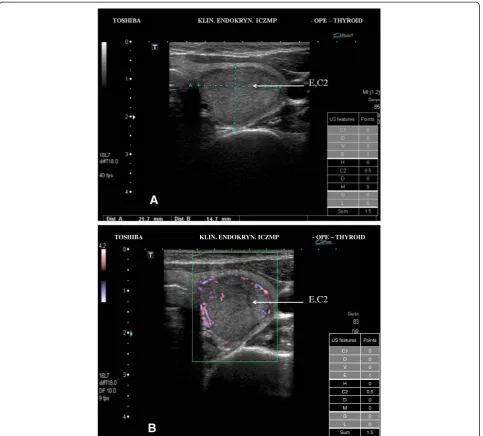 Figure 2 Low risk thyroid nodule/focal lesion US pattern. A. Ultrasound picture of the thyroid lesion (B-mode)