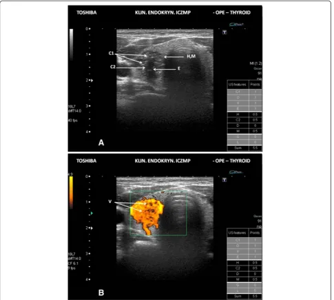 Figure 3 Intermediate risk thyroid nodule/focal lesion US pattern. A. Ultrasound picture of the thyroid lesion (B-mode)