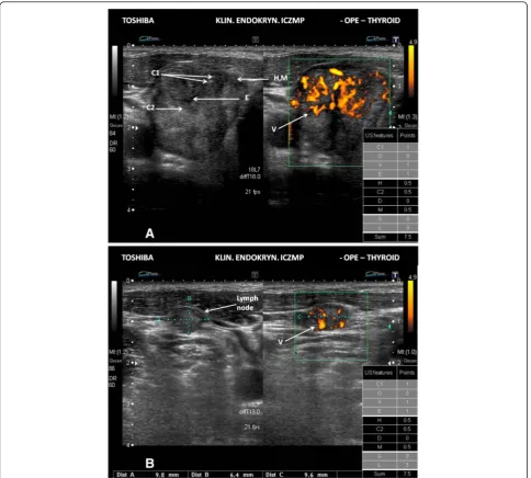 Figure 4 High risk thyroid nodule/focal lesion US pattern. A. Ultrasound picture of the thyroid lesion (B-mode, Power Doppler)