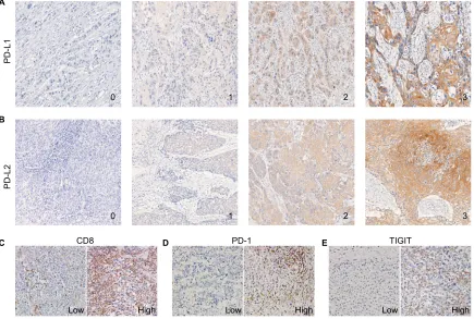 Figure 1 Expression patterns of PD-L1, PD-L2, CD8, PD-1, and TIGIT in ESCC samples.Abbreviations:Notes: (A and B) Representative immunohistochemical images of PD-L1 and PD-L2 expressions, which were scored from 0 to 3+