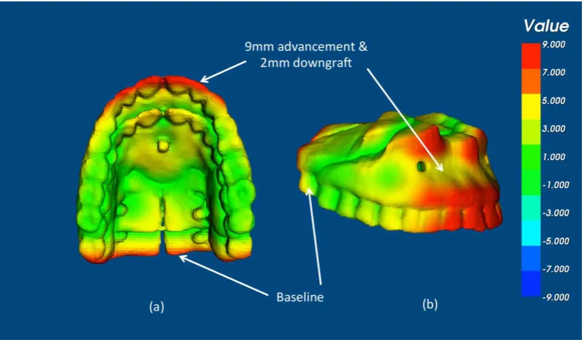 Figure 4 Using VRMesh the skull images were deleted leaving only the 