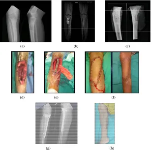 Figure 2. (a) and (b) Properative radiograph and MRI showing proximal tibia lesion; (c) Specimen radiograph; (d) Intraop- erative picture showing remaining proximal tibia with tuberosity and sural pedical; (e) Biologic reconstruction with vascu- 