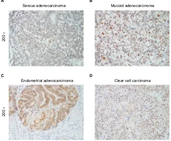 Figure S2 Representative immunohistochemical images of four histological types of epithelial ovarian cancer tissues (Notes:×200)