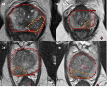 Figure 1: Staging and pre-treatment MRI . (a) and (b) are from staging and 