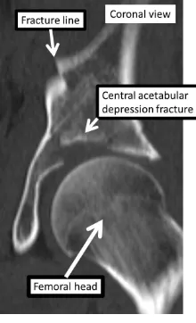 Figure 1. Two-dimensional coronal plane CT scan of the central acetabular depression fracture