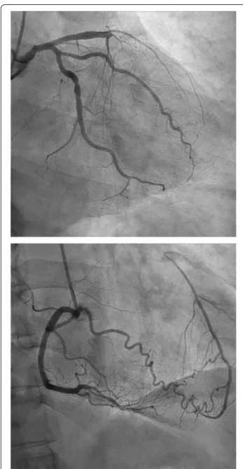 Fig. 1  Coronary angiogram of a 58-year-old patient with stable 