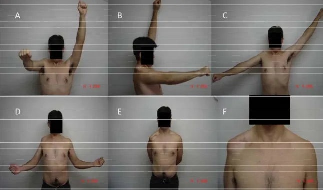 Figure 3. Active mobility results in the postoperative period. (A/B) Flexion; (C) Abduction; (D) External rotation; (E) Inter-n al rotation; (F) Cosmetic appearance