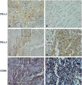 Figure 1. Expression of PD-L1 and CD68 in mononuclear cells in TGCT. (A) Membranous staining of PD-L1 was observed as a positive control in lung cancer, original magnification, ×400