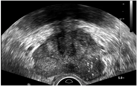 Figure 1 suspicious lesion on TRUs (rim margin marked by cross).Abbreviation: TRUs, transrectal ultrasound.