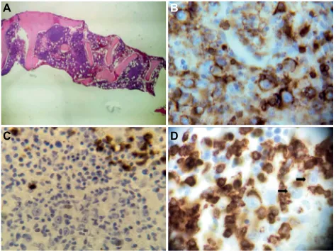 Figure 3 Pathology diagnosis in hematological malignancies.Notes: (A) Bone marrow biopsy of a T-cell-rich/diffuse large B-cell lymphoma