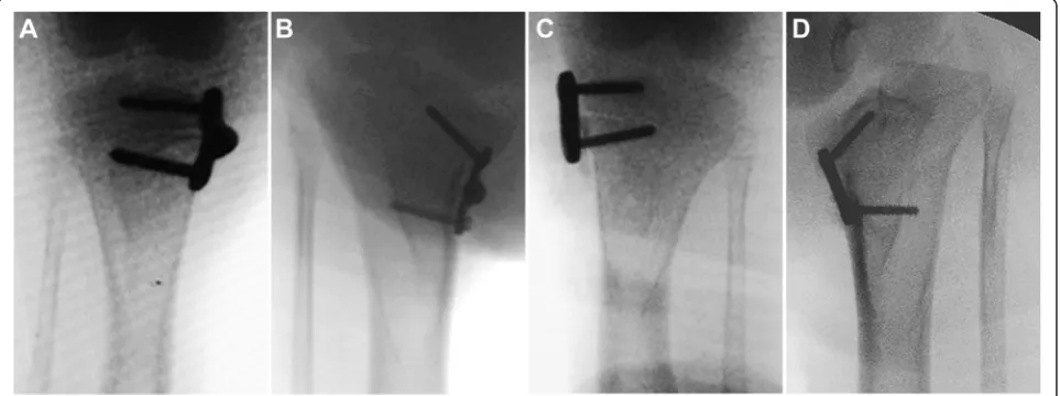 Figure 4 Measurements on standard anterioposterior radiographof the knee joint. MSA, medial slope angle; MPTA, medial proximaltibial angle; and ATA, angle of the two arms.