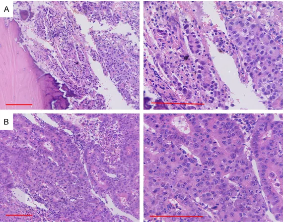Figure 4. Immunohistochemical analysis of mandibular metastatic carcino-ma. Glypican-3 and Hep Par-1 are two biomarkers that are helpful for deter-mining the metastatic hepatocellular carcinoma origin
