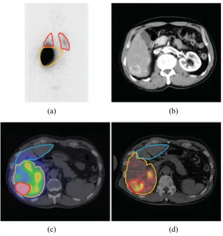 Figure 1. Result of a planar Tc-99 MAA scan with the regions of interest: liver (yellow) and lung (red) (a) with reference to the contrast-enhanced CT image in (b)