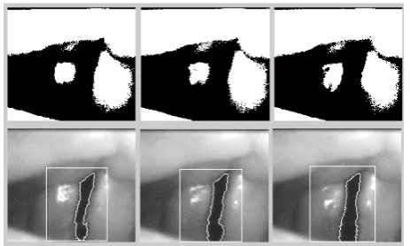 Figure 6. Serial segmentation results: the rectangle marks the defined ROI within which a restricted thresholding is performed to delineate the glottis (outlined)