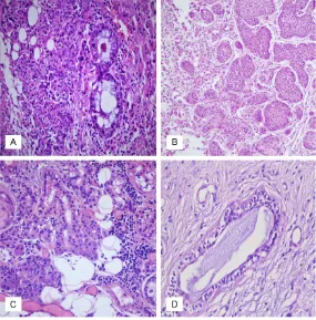 Figure 1. A selection of metaplastic changes. A. Mucinous metaplasia char-acterised by an increased number of mucous cells lining striated ducts