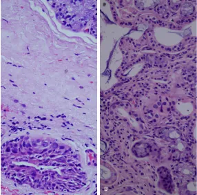 Figure 11. Increased Ki-67 immunohistochemical staining is apparent within the area of adenomatoid ductal hyperplasia in contrast to the surrounding tis-sue (H&E, ×100)