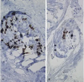 Figure 12. High level Ki-67 (A) and p53 (B) expression in the previously shown (Figure 10A) dysplastic excretory duct (H&E, ×400).