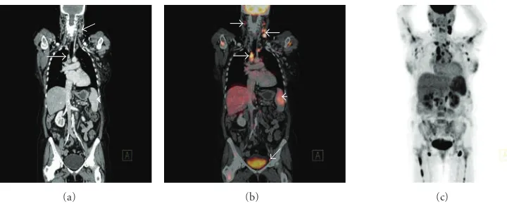 Figure 3: Coronal CT (a) demonstrating left cervical and right paratracheal lymphadenopathy (white arrows) and mild splenomegaly(white arrowhead) consistent with high-grade follicular lymphoma