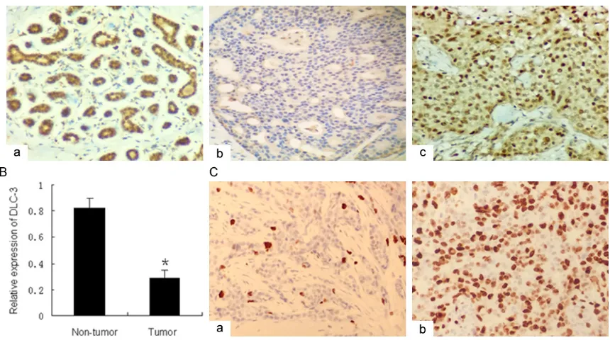 Figure 1. DLC-3 expression was frequently down-regulated in TNBC. (A) IHC results of DLC-3 expression in adjacent noncancerous and breast cancer tissue samples