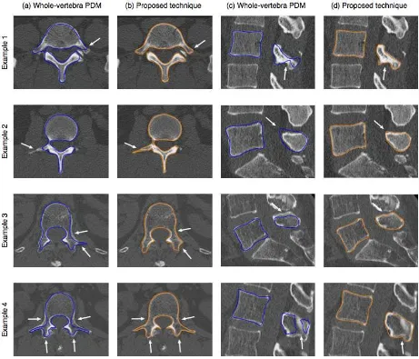 Figure 10.Abnormal population: Comparison of the mean error distribution between the whole-vertebra PDM reconstruction and our part-based PDMreconstruction