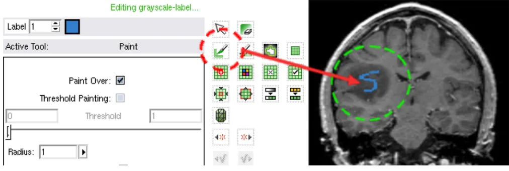 Figure 3.Use the editing tool to draw a stroke in one slice. On the left, the red circle is the paint tool;