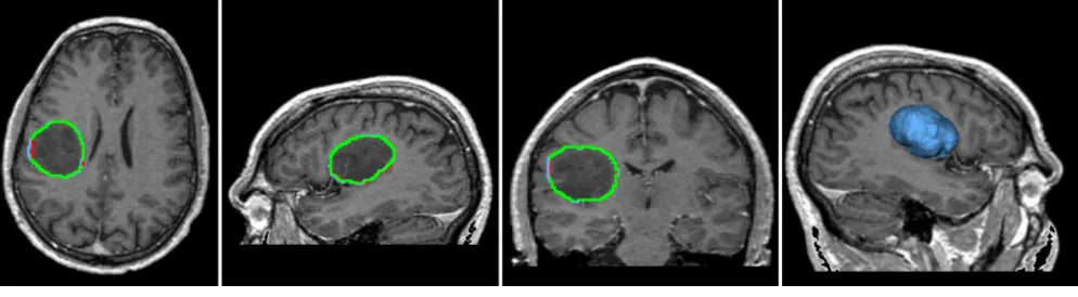 Figure 4.Segmentation of the meningioma using proposed algorithm and module in 3D Slicer