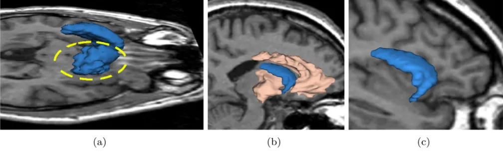 Figure 10.If we only place seeds in caudate we get segmentation in Sub-figure 10(a) where the leakage
