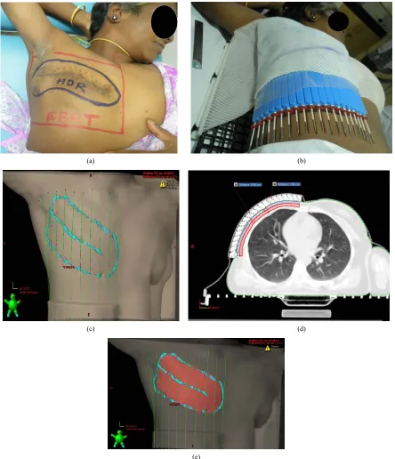 Figure 2. Method for CTV delineation: (a) Surface markings made on the patient; (b) Mould is prepared with immobilization and in the same position as in EBRT; (c) 3D view of the surface wire markings; (d) CTVhdr_evl (red) and overlying skin 