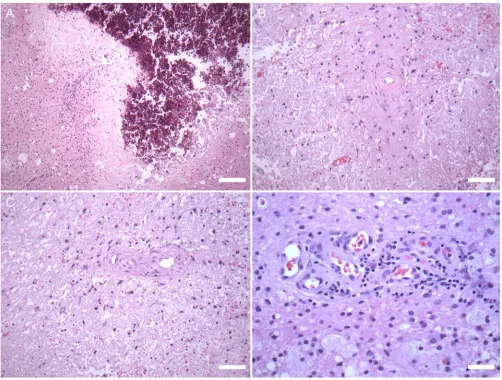 Figure 3. Brain histopathology, hematoxylin and eosin. The white matter has ill-defined areas of 