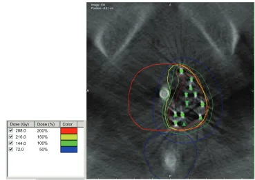 Figure 2 Representative image of a focal brachytherapy implant. Notes: Contours of the prostate in red, urethra in green, and rectum in blue