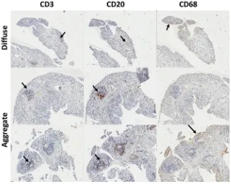 Fig. 1. Lineage cell detection in OA synovial tissue. IHC for T-cells (CD3) B-cells (CD20) and macrophage (CD68) in three typical OA biopsies with diffuse, aggregates or germinalcentre like structure tissue architecture.