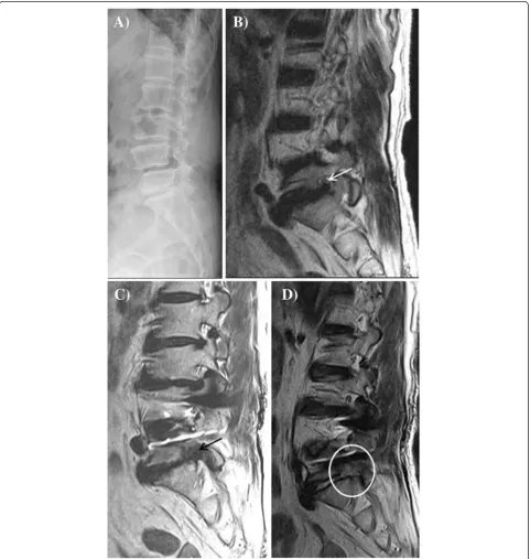 Figure 1 Imaging of degenerative spondylolisthesis in a 65-year-old woman. (A) Lateral radiography reveals degenerative spondylolisthesis atL4-5 and decreased disc height at the L5-S1 level