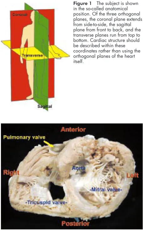 Figure 3This shows the opened right atrium in attitudinally correctposition. The dots delimit the triangle of Koch