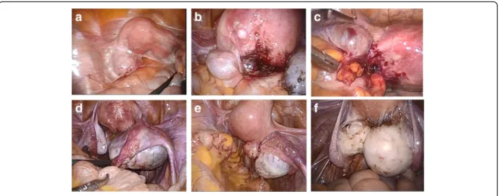 Figure 2 shows the sequential changes in the serum AMH levels. Both groups had significant decreases in the serum AMH levels at 1 month and 1 year after surgery compared to the preoperative levels