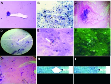 Figure 1 The genesis of embryoid bodies is intimately linked to displacement and migration of biological crystals derived from intercellular collision of tumor cell membranes