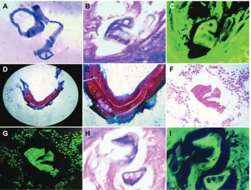 Figure 5 embryoid bodies have the capability to generate fractal and mirror images. (A) Detachment subimage of (B) image revealing fractal components which converge in well-developed embryoid body in a case of peritoneal carcinomatosis ascitic fluid, Papan