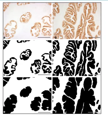 Figure 1. In (a) and (b) the images shown are from a specimen of CTR group and a case of BPH group respectively, immunostained to PSA