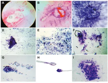 Figure 1 initiator phase of geometric triangular chiral hexagonal like crystal complex assembly in malignant tumors